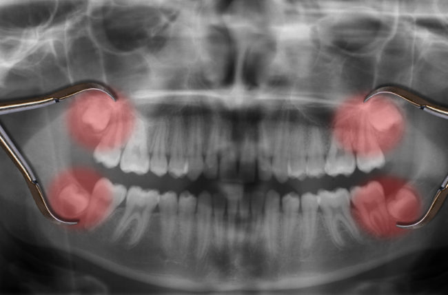 Why Do We Get Wisdom Teeth?